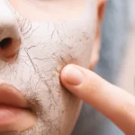 درمان ترک پوستی 1